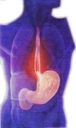 What You Should Know About Heartburn and Acid Reflux