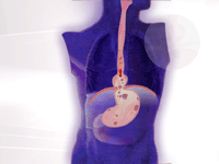 How to Cure and Prevent Persistent Heartburn