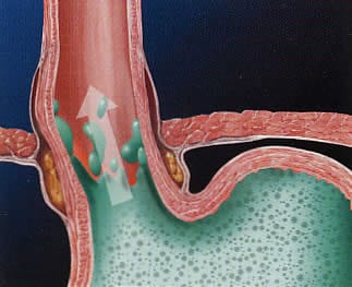 What is the Difference between Heartburn and GERD