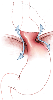 Do Not Ignore Heartburn and Nausea