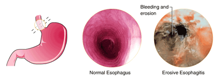 What is Chronic Heartburn