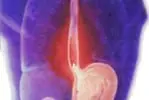 Heartburn