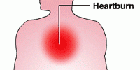 Heartburn