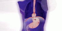 Acid reflux or GERD