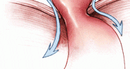The anatomy of persistent heartburn