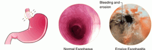 internal view of severe heartburn